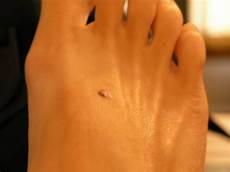 Flat Foot Sole