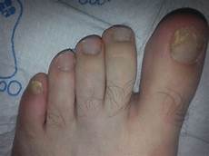 Diabetic Shoes